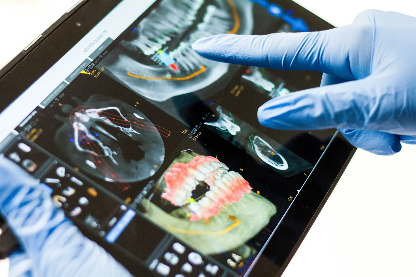 CBCT implant planning reviewed on a tablet, shown while covering Implant Crown in Virginia Beach