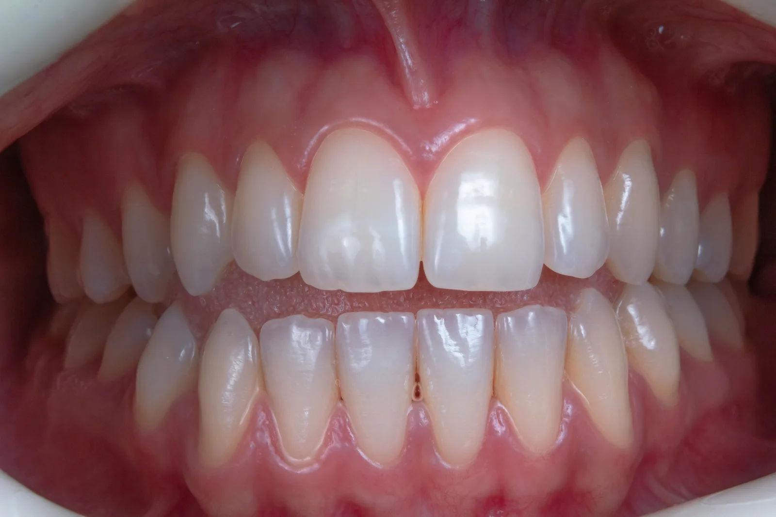 Full arch intraoral view of the teeth, shown while covering Implant Financing in Virginia Beach