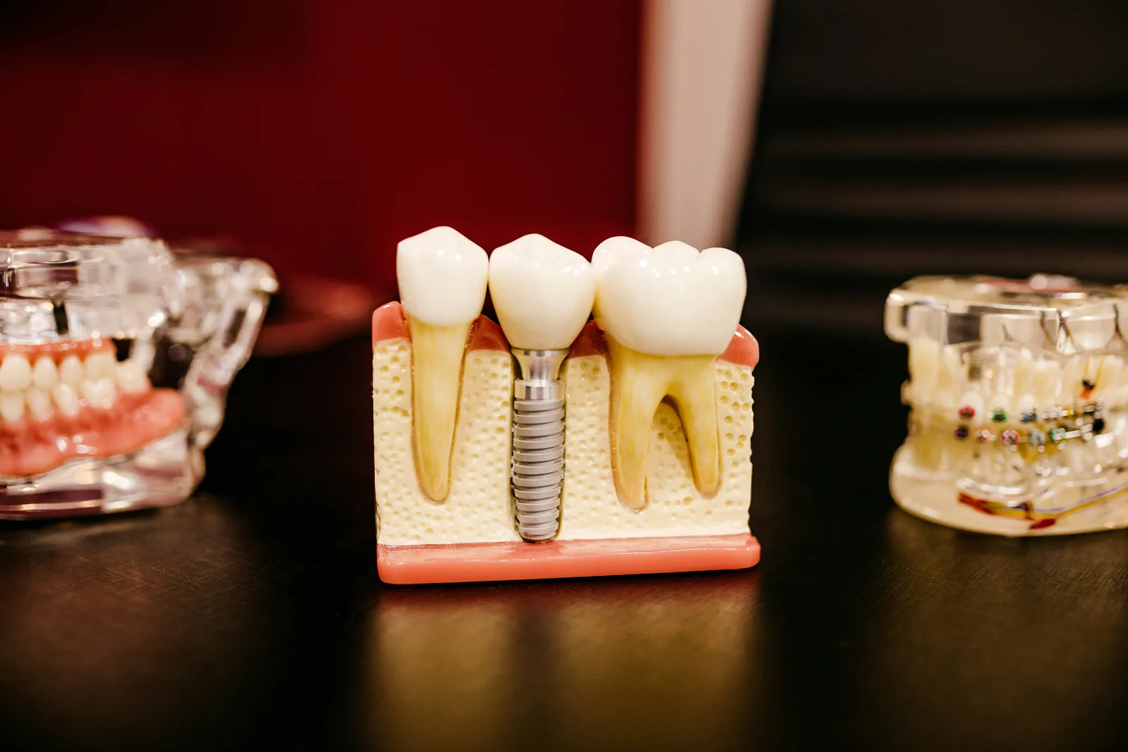 Cross-section model showing an implant in the jawbone, shown while covering dental implant treatment in Virginia Beach