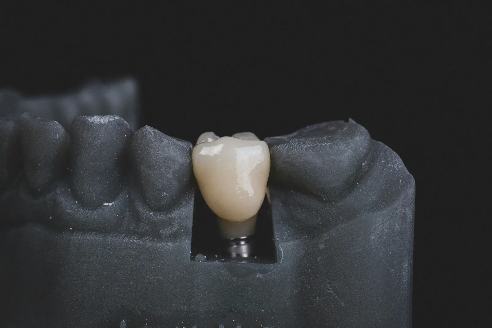 Implant crown seated on a working model, shown while covering Implant Services in Virginia Beach
