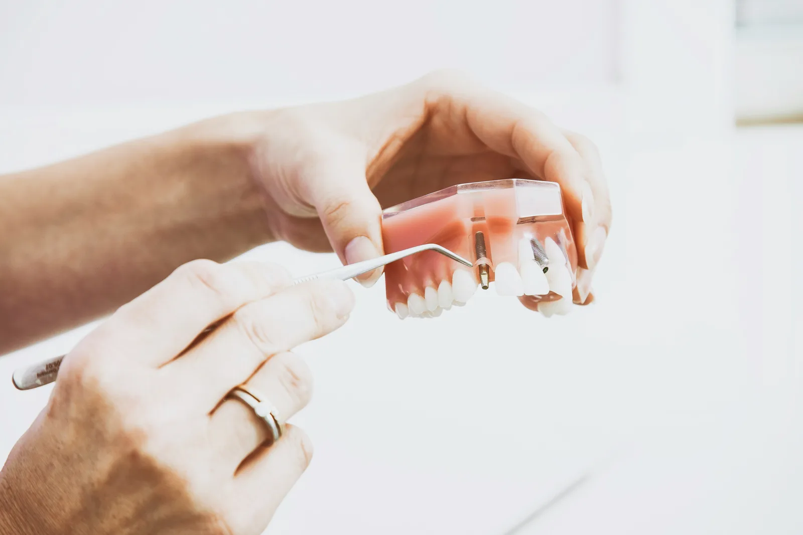 Implant model examined with a dental probe, shown while covering Guided Implant Surgery in Virginia Beach