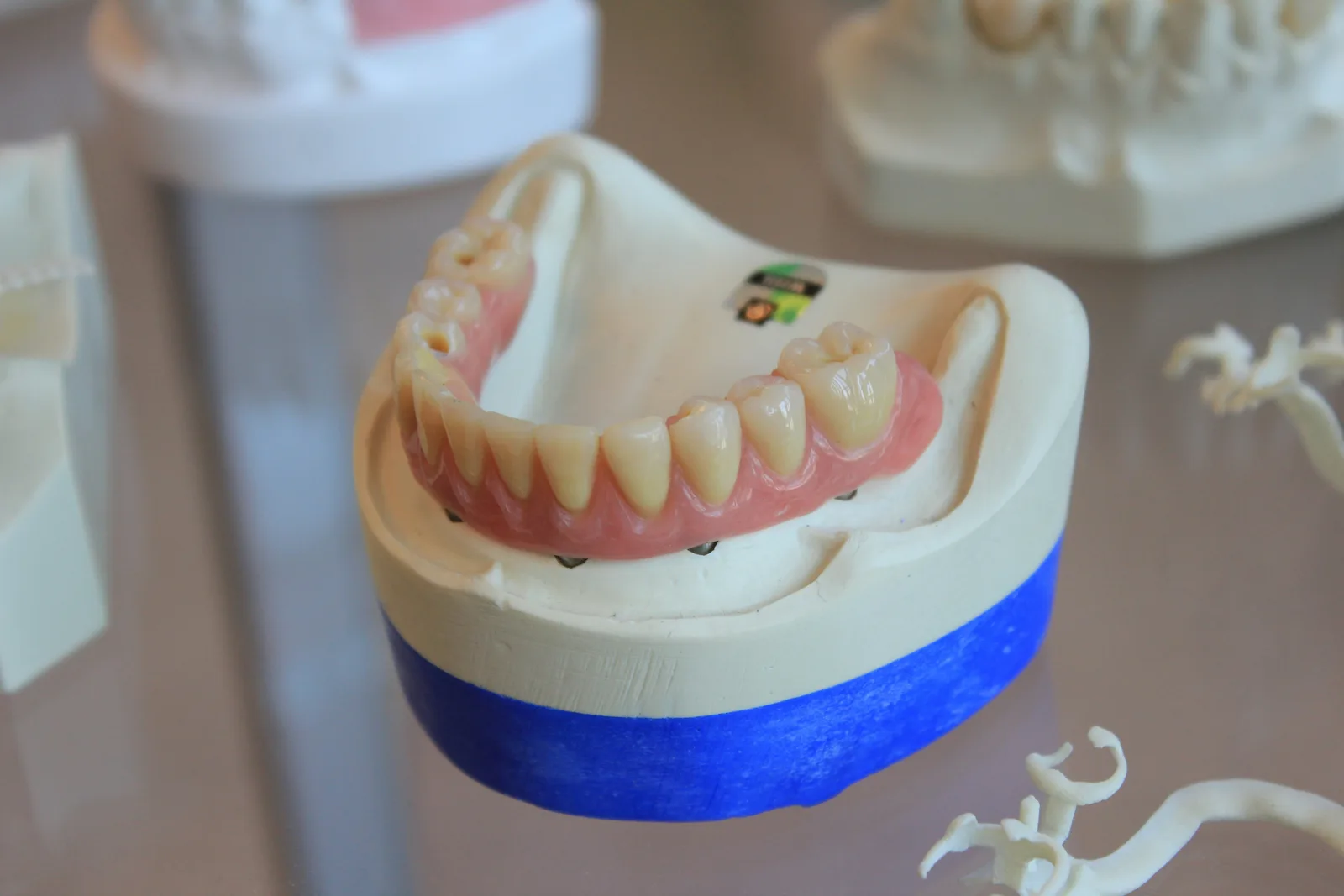 Implant supported denture on a study model, referred to in the Implant Crown section for Virginia Beach