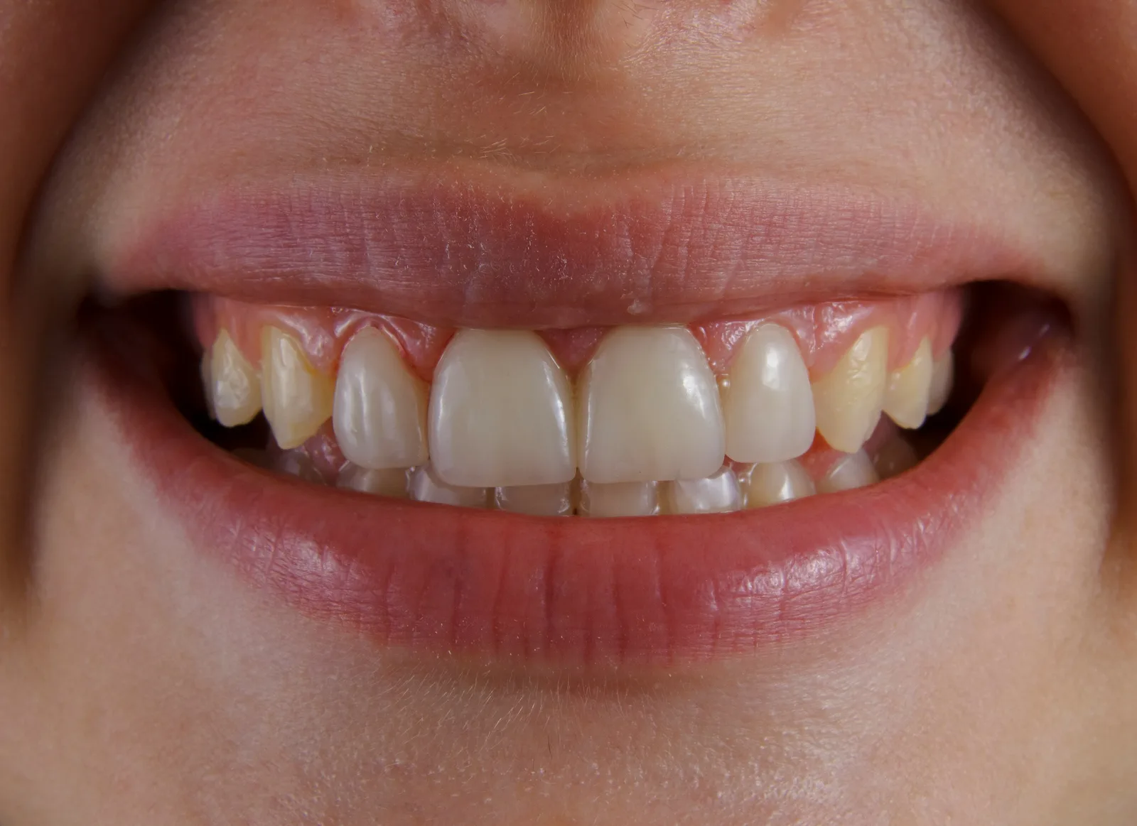 Close-up of a natural smile, referred to in the Guided Implant Surgery section for Virginia Beach
