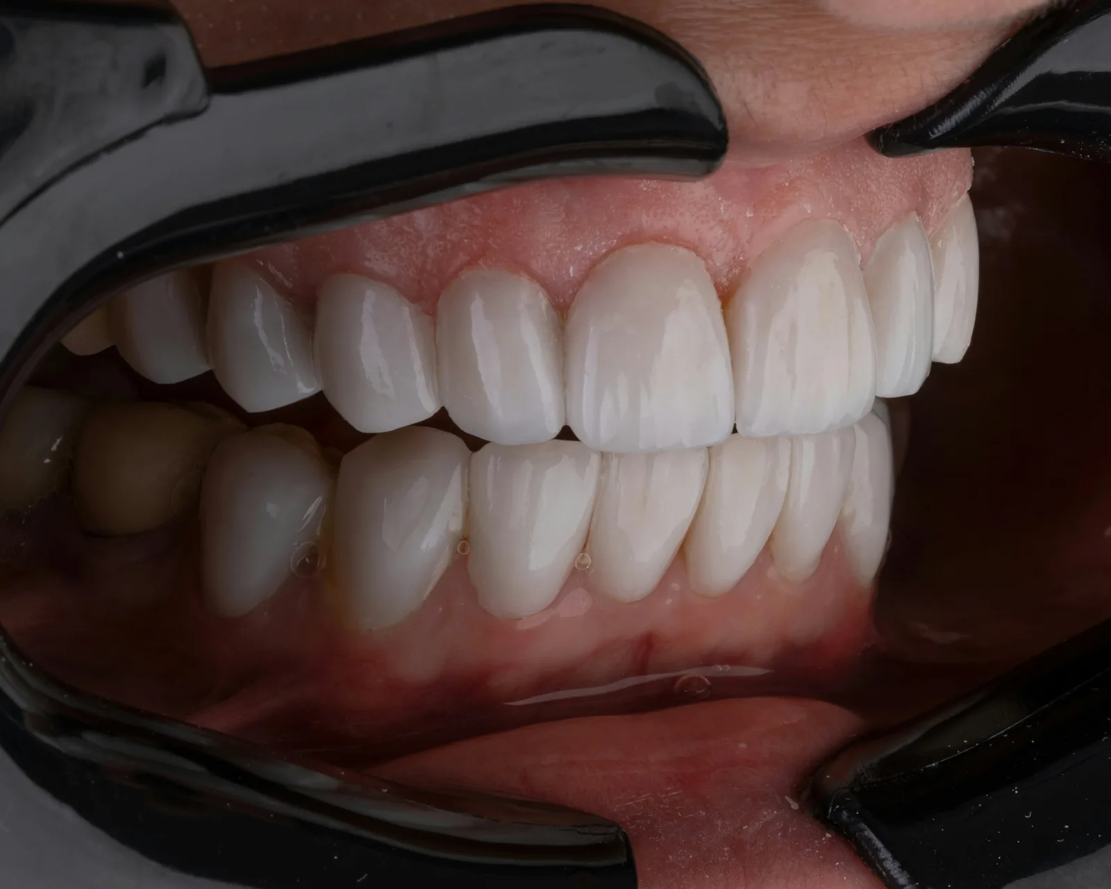 Intraoral view of several restored teeth in one arch, after multiple tooth implants in Virginia Beach