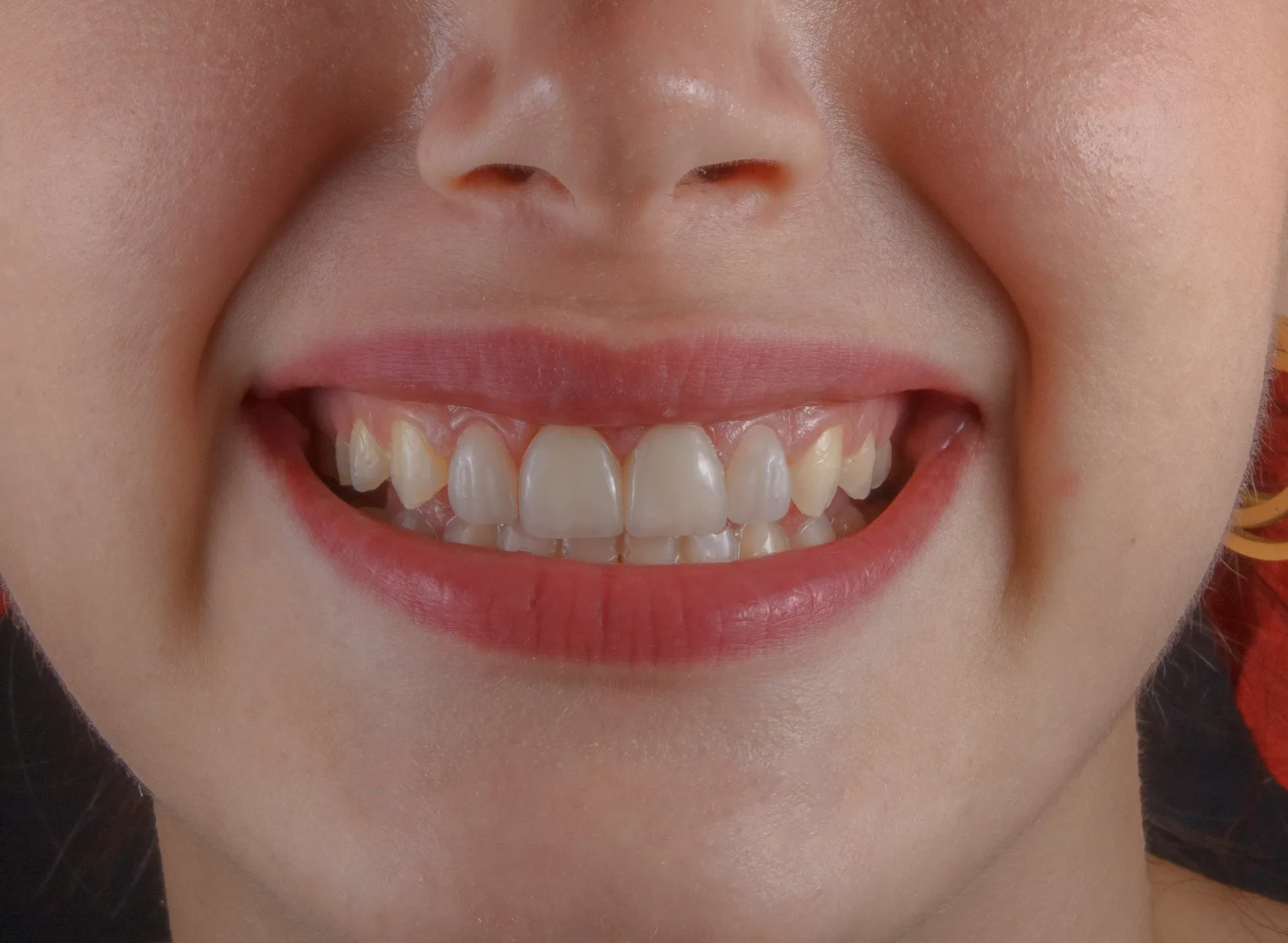 Close-up of a smile before treatment, shown while covering Implant Consultation in Virginia Beach