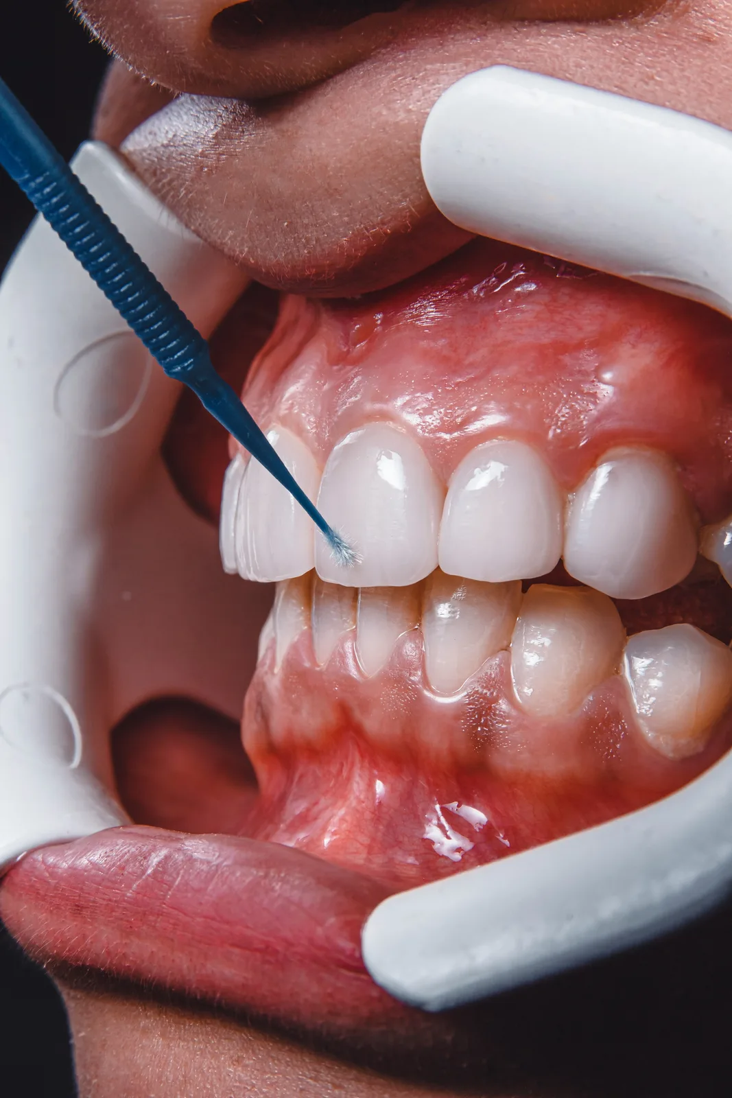 Tooth preparation with cheek retractors in place, alongside the Guided Implant Surgery explanation in Virginia Beach