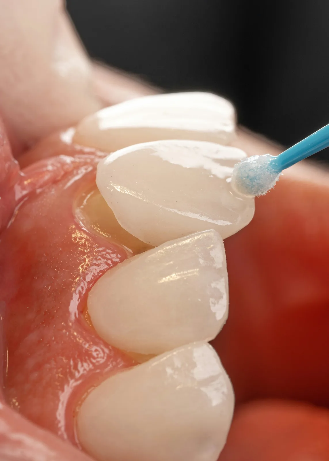 Close-up of tooth surface preparation, referred to in the Ridge Augmentation section for Virginia Beach